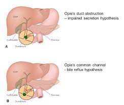 Maybe you would like to learn more about one of these? Gallstone Related Pathogenesis Of Acute Pancreatitis Pancreapedia
