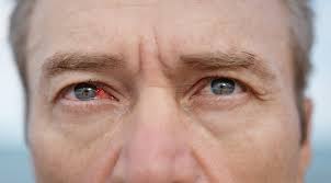 Image result for Viral Conjunctivitis