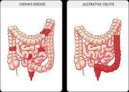 A validated score used to assess disease activity in crohn disease calculated using the following variables, assessed over the course of one week Crohn S Disease