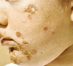 Infectiile stafilococice se raspandesc usor prin: Impetigine L Antibiotico E D Obbligo