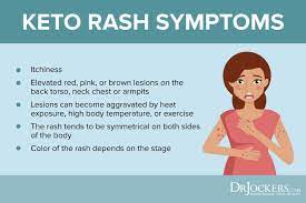 Keto Rash Causes And Natural Treatments Keto Rash Rash Treatment Keto