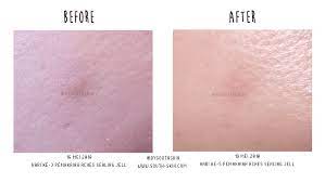South Skin Com Mentholatum Acnes Sealing Jell Review