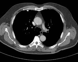 /æsˈbɛstəs/ or /æsˈbɛstɒs/) is a term used to refer to six naturally occurring silicate minerals. 5 3 Pathologies Respiratoires Biotechnologies St2s