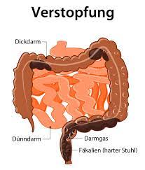 Verstopfung bezeichnet ein symptom der gestörten darmpassage. Verstopfung