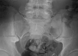 Imaging Findings Of Metabolic Bone Disease Radiographics