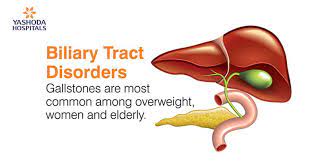 Of or relating to bile, the bile ducts, or the gallbladder. How To Treat Biliary Tract Disorders Gallstones