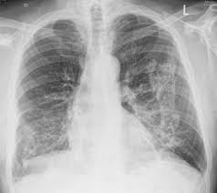 Asbestosis is a chronic lung condition that develops after years of asbestos exposure. Asbestosis Radiology Case Radiopaedia Org