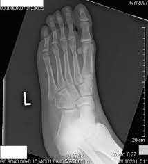 Grade 1 (g1) means the cancer looks much like normal bone tissue. Chondroblastic Osteosarcoma Of The Cuboid A Literature Review And Report Of A Rare Case Sciencedirect