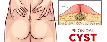 Image result for Pilonidal Cyst