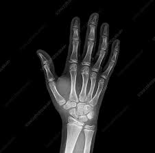 Image result for Wrist XRay