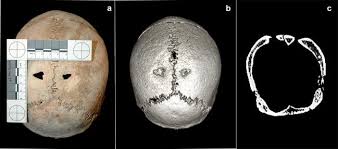 Image result for Skull Trephination