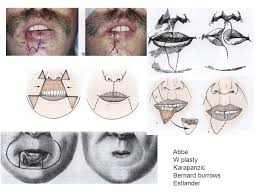 It takes the form of a large leathery slender flap and is found in the caribbean area at depths down to 100 metres (330 ft). Cummings Chap 24 Reconstruction Of Facial Defects Ppt Video Online Download
