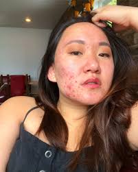 She's not ashamed of her acne any more: how the skin positivity movement  helps those with severe breakouts learn to feel good in their own bodies