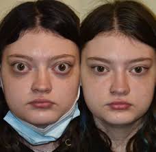 eyelid reconstruction to treat bulging eyes (Not OP) : r/PlasticSurgery