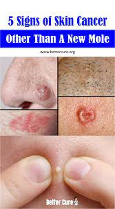 Skin cancer pictures by type. Pin On Medicine Neuroscience