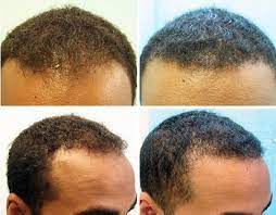 Black afro hair transplants (ie. Black Men Fue Hair Transplant Using 1200 Grafts