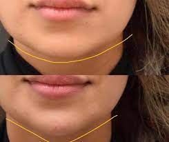 هناك العديد من النصائح والطرق التي تعمل على تطويل الذقن، ومنها:٣. ØªÙ‚Ø¯ÙŠÙ… Ùˆ Ø§Ù„Ø¯ÙƒØªÙˆØ± Ù…Ø­Ù…Ø¯ Ø§Ù„Ø³ÙˆÙŠØ·ÙŠ Medical Beauty Center Ø§Ù„Ù…Ø±ÙƒØ² Ø§Ù„Ø·Ø¨ÙŠ Ø§Ù„ØªØ¬Ù…ÙŠÙ„ÙŠ Mbc Facebook