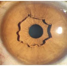 Ring Im Auge Dieses Phanomen Ist Eine Spielart Der Natur Stern De