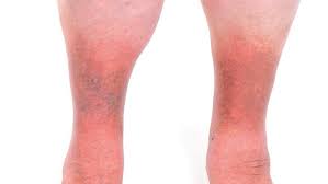 Image result for Lipodermatosclerosis