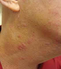 To understand lupus, it helps to know how the immune system works. Skin Disease In Cutaneous Lupus Erythematosus Sciencedirect