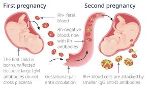 Image result for Rh Sensitization