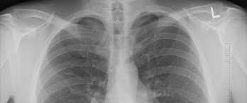 Mesothelioma In The Uk What Is It And How May It Be Caused