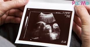 Fibroid juga dapat memberikan tekanan pada kandung kemih. Minggu Ke 36 Patut Kepala Ke Bawah Kuantiti Air Ketuban Uri Bawah Cyst Fibroid Antara Punca Bayi Songsang Pa Ma