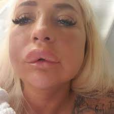 Adult star Bambi Black rushed to A&E after severe allergic reaction to lip  job - Mirror Online