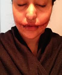A glasgow smile is no laughing matter and is the infliction of an incision from the corner of the mouth to the ears and result in death or a scar in the shape of a smile. Suhanhanifa On Twitter Glasgow Smile Stages Of Healing Part 1 Halloween Makeup Sfx Http T Co 4zjrqfnhyl