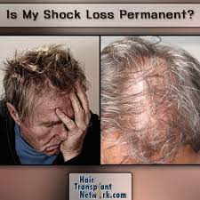 While the hair is shed due to trauma, the dermal papilla. Is My Shock Loss From My Hair Transplant Permanent Low Level Laser Therapy Lost Hair Hair Transplant
