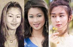 Eliza Sam Had Eyelid Surgery Eyelid Surgery Surgery Plastic Surgery