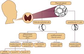 Learn more about the prognosis associated with thyroid cancer, how it is treated and how it presents in this. Thyroid Cancers Of Follicular Origin In A Genomic Light In Depth Overview Of Common And Unique Molecular Marker Candidates Molecular Cancer Full Text