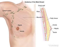 Breast cancer is cancer arising in breast tissue. Breast Cancer Medlineplus Genetics