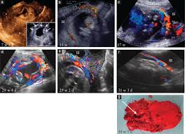 21 semaines de grossesse / 23 sa. Cesarean Scar Pregnancy Is A Precursor Of Morbidly Adherent Placenta Timor Tritsch 2014 Ultrasound In Obstetrics Amp Gynecology Wiley Online Library
