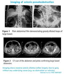 Image result for Adynamic Ileus