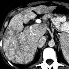 Budd Chiari Syndrome Radiology Key