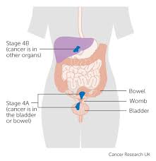 Stage 4 Womb Cancer Cancer Research Uk