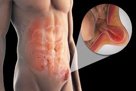 Image result for stomach hernia symptoms