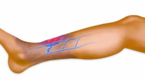 La trombosi è un processo patologico che consiste nella formazione di trombi all'interno dei vasi sanguigni, che ostacolano o impediscono la normale circolazione del sangue. La Trombosi Venosa Superficiale Aspetti Pratici Per Il Medico Di Medicina Generale