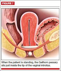 Image result for Pessary