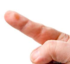 An eye blister is a benign growth which can appear on the whites of the eyes or on the cornea itself. What Is The Difference Between A Blood Blister And A Water Blister