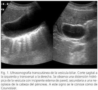 Hallazgo Ecográfico De Distensión Hídrica Vesicular E Hidrops Biliar, Generada Por Ia