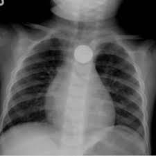Button Battery in Esophagus