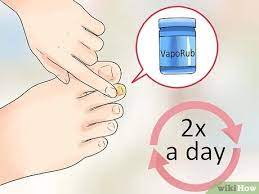 Remedios caseros hongo uña pie dedo gordo. Como Eliminar Los Hongos De Los Pies Ayudan Los Remedios Caseros