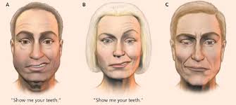 Bell's palsy adalah suatu kondisi otot wajah yang lemah atau lumpuh karena saraf terganggu, kenali gejala dan bagaimana cara menanganinya. Mengenal Penyakit Bell S Palsy Lontaradhygita