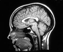 Maybe you would like to learn more about one of these? Las Pruebas De Resonancia Magnetica Ayudan A Predecir La Progresion De La Esclerosis Multiple Gaem Grupo De Afectados De Esclerosis Multiple