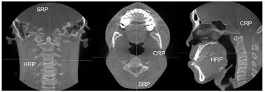 The cortical bone equivalent area of the cross‐section of the region of interest (femoral neck or shaft), with all soft tissue voids (trabecular and cellular spaces) eliminated (cm 2). Changes In Hyoid Bone Position And Cross Sectional Area Of Pharyngeal Airway After Oral Cancer Surgery Anticancer Research