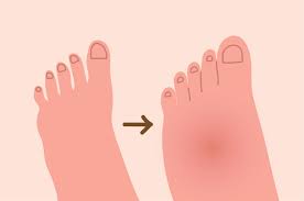 Pembengkakan di kaki setelah keseleo biasanya menunjukkan seberapa parah kita mengalami cedera. Kebiasaan Yang Bisa Menyebabkan Kaki Bengkak Saat Hamil