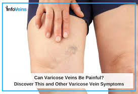 We did not find results for: Can Varicose Veins Be Painful Azura Vascular Care