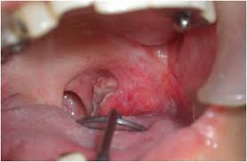 Image result for spinocellular carcinoma of the oral cavity